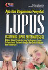 Apa dan Bagaimana Penyakit LUPUS (Sistemik Lupus Eritematosus)